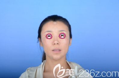 鞏敏醫(yī)生給我做下巴和淚溝及眉間異物取出修復(fù)頭一日樣子