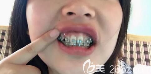 我在深圳弘和口腔做牙齒矯正剛戴牙套