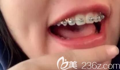 我在深圳弘和口腔做牙齒矯正第5個月