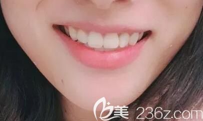 門牙有縫+深覆頜,在深圳牙科排前十名的弘和口腔做金屬托槽牙齒矯正1年多下牙套啦