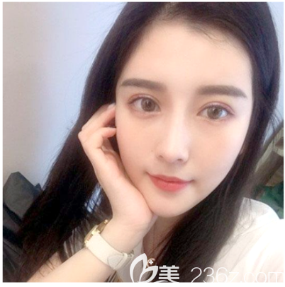 在中信惠州醫(yī)院整形科做完雙眼皮一個(gè)月了 在中信惠州醫(yī)院整形科做完雙眼皮一個(gè)月了