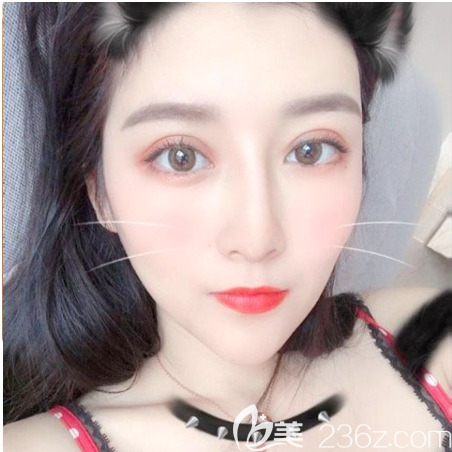 惠州割雙眼皮哪家醫(yī)院好？看我找中信惠州醫(yī)院整形美容科陳虹做的雙眼皮效果怎么樣