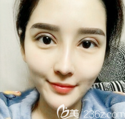 中信惠州醫(yī)院整形美容科雙眼皮8天拆線 中信惠州醫(yī)院整形美容科雙眼皮8天拆線