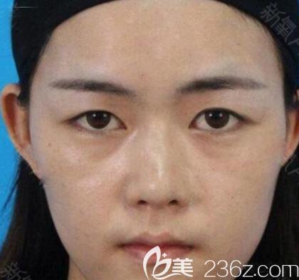 去中信惠州醫(yī)院整形美容科做雙眼皮術(shù)前照片 去中信惠州醫(yī)院整形美容科做雙眼皮術(shù)前照片
