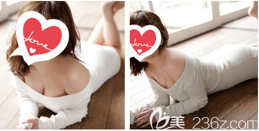 假體隆胸術后一個月恢復效果圖