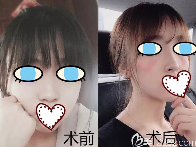 南寧華美整形胡凱假體隆鼻案例