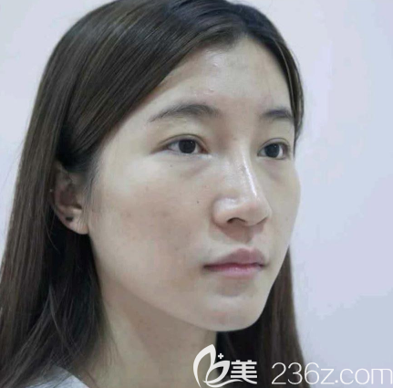 在中信惠州醫(yī)院整形科做脂肪填充術(shù)前照片 在中信惠州醫(yī)院整形科做脂肪填充術(shù)前照片