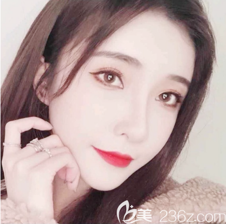 中信惠州醫(yī)院整形科脂肪填充術(shù)后一個月自拍 中信惠州醫(yī)院整形科脂肪填充術(shù)后一個月自拍