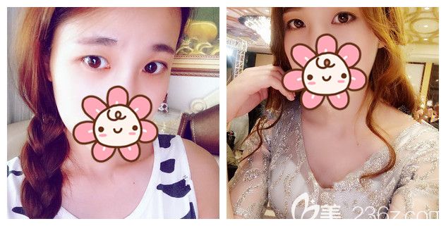 面診<!--<i data=20240703-sp></i>-->術(shù)前內(nèi)雙眼睛 面診<!--<i data=20240703-sp></i>-->術(shù)前內(nèi)雙眼睛