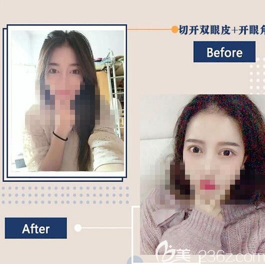 洛陽華美雙眼皮整形前后對比