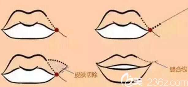 嘴角上揚術(shù)的過程