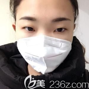 在石家莊天伊美做雙眼皮術(shù)前是腫泡眼 在石家莊天伊美做雙眼皮術(shù)前是腫泡眼