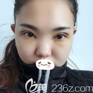 張柏松醫(yī)生為我做雙眼皮術(shù)后即刻效果 張柏松醫(yī)生為我做雙眼皮術(shù)后即刻效果