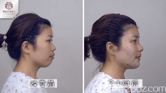 我在北京上上相改善凸嘴前和手術(shù)兩小時后對比效果 我在北京上上相改善凸嘴前和手術(shù)兩小時后對比效果