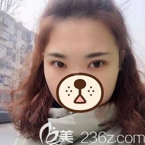 在石家莊天伊美做雙眼皮術(shù)后一周進(jìn)行拆線 在石家莊天伊美做雙眼皮術(shù)后一周進(jìn)行拆線