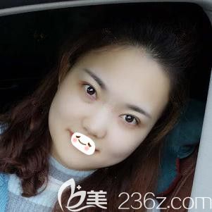 張柏松醫(yī)生為我做切開雙眼皮16天完全消腫 張柏松醫(yī)生為我做切開雙眼皮16天完全消腫