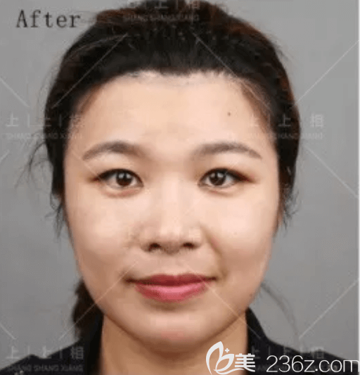 我在北京上上相做ART自體脂肪骨性移植技術(shù)改善凸嘴恢復(fù)中效果 我在北京上上相做ART自體脂肪骨性移植技術(shù)改善凸嘴恢復(fù)中效果