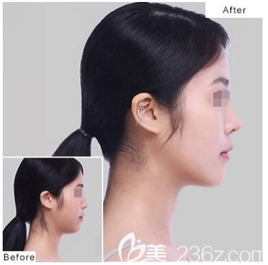 連云港俏臉在當(dāng)?shù)乜诒趺礃?2019到院整形的話有價(jià)格表沒(méi)?眼鼻胸線雕這些熱門(mén)項(xiàng)目有沒(méi)有優(yōu)惠