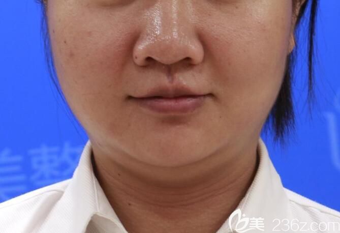 本來準備去合肥華美整形打瘦臉的，面診后朱德綱給我做了面部吸脂瘦臉，1個月感覺臉小了一圈