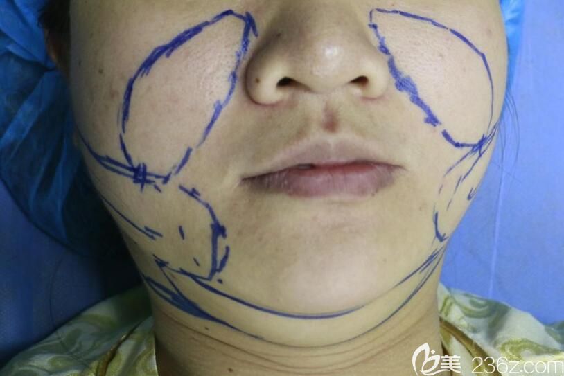 合肥華美吸脂瘦臉術(shù)前設(shè)計 合肥華美吸脂瘦臉術(shù)前設(shè)計