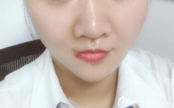 朱德綱做面部吸脂瘦臉術(shù)后33天效果圖 朱德綱做面部吸脂瘦臉術(shù)后33天效果圖