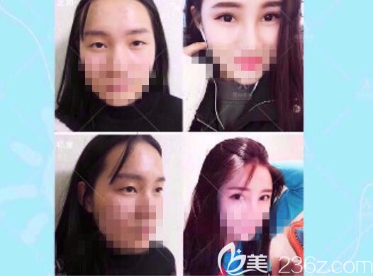 愛尚雙眼皮案例展示