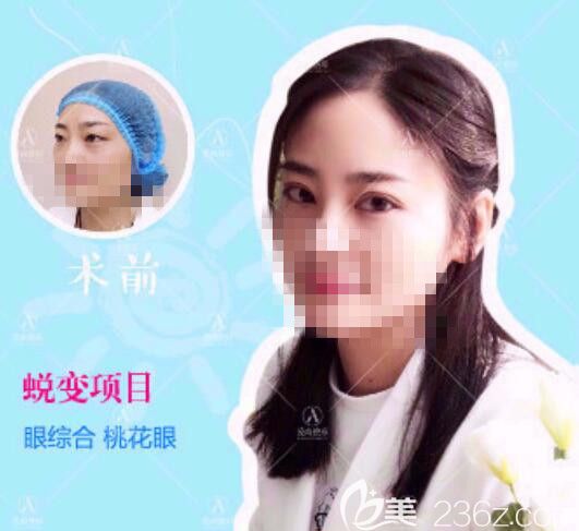 愛尚雙眼皮案例