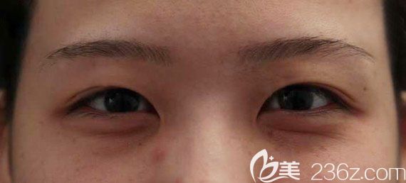 韓國奧納比整形醫(yī)院張哲豪眼底眶隔脂肪釋放術(shù)案例 韓國奧納比整形醫(yī)院張哲豪眼底眶隔脂肪釋放術(shù)案例