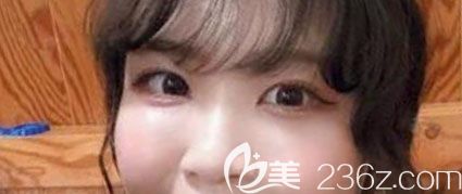 韓國奧納比整形醫(yī)院去眼袋術(shù)后1個(gè)月案例恢復(fù)圖 韓國奧納比整形醫(yī)院去眼袋術(shù)后1個(gè)月案例恢復(fù)圖