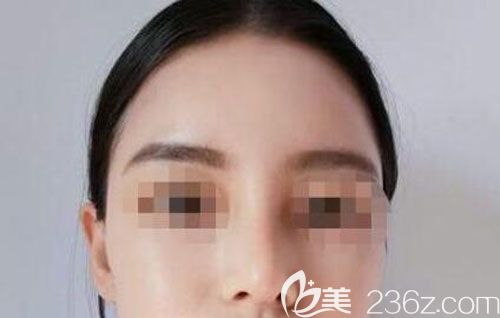 假體隆鼻第7天拆線沒有任何外露的傷口和異物感