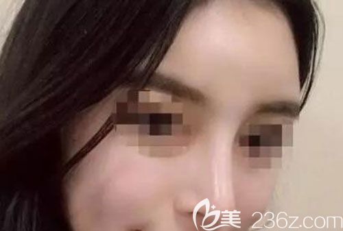 耳軟骨墊鼻尖已經(jīng)一個(gè)月顏值提升了幾個(gè)臺(tái)階