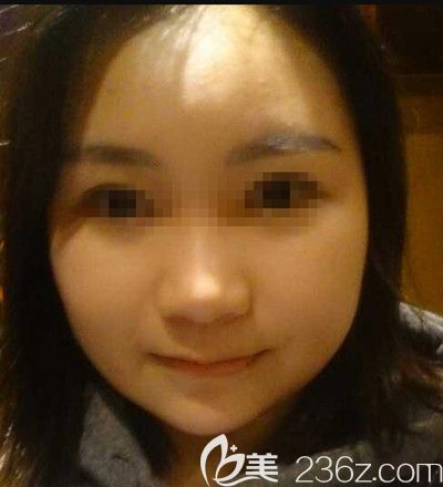 在韓國small face整形醫(yī)院做顴骨縮小+下頜角+脂肪填充術后2周 在韓國small face整形醫(yī)院做顴骨縮小+下頜角+脂肪填充術后2周