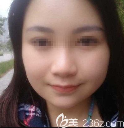 在韓國small face整形醫(yī)院做顴骨縮小+下頜角+脂肪填充術后2個月 在韓國small face整形醫(yī)院做顴骨縮小+下頜角+脂肪填充術后2個月