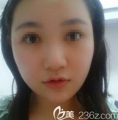 在韓國small face整形醫(yī)院做顴骨縮小+下頜角+脂肪填充術后4個月 在韓國small face整形醫(yī)院做顴骨縮小+下頜角+脂肪填充術后4個月