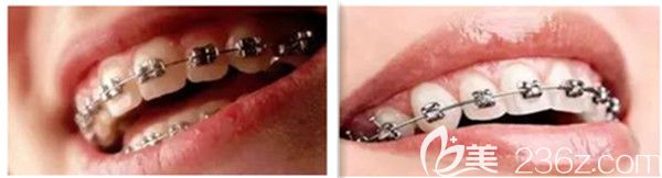 自鎖托槽和普通托槽的區(qū)別