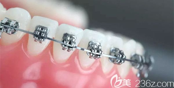 自鎖托槽的圖片