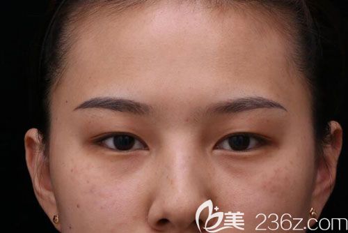 祛斑手術(shù)前 祛斑手術(shù)前