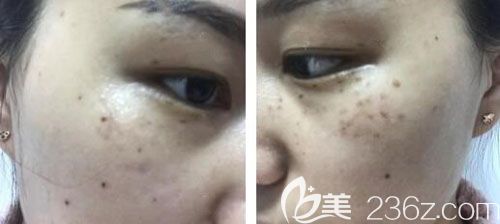 激光祛斑第7天臉上痂已經(jīng)脫落 激光祛斑第7天臉上痂已經(jīng)脫落