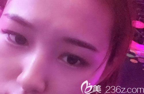 皮秒激光祛斑第15天皮膚越來(lái)越有光澤 皮秒激光祛斑第15天皮膚越來(lái)越有光澤