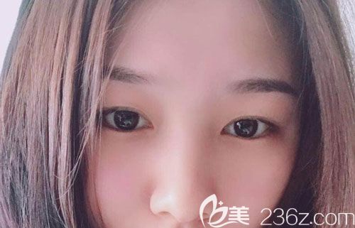 曲靖激光祛斑哪家醫(yī)院做的好?曲靖靖美趙錫泰皮秒激光祛斑一個月后讓我不再是小黑妹了