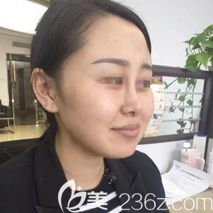 在石家莊天伊美注射海薇玻尿酸術(shù)前是短下巴 在石家莊天伊美注射海薇玻尿酸術(shù)前是短下巴