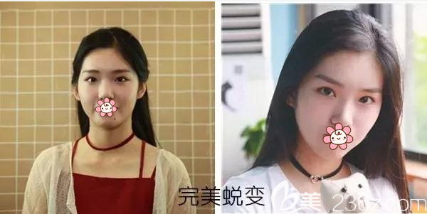 宜賓韓美全面部脂肪填充術(shù)前術(shù)后對(duì)比效果圖