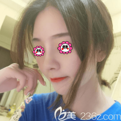 張曉亮醫(yī)生給我做肋軟骨隆鼻第20天效果