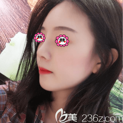 在北京壹加壹做肋軟骨隆鼻第53天樣子