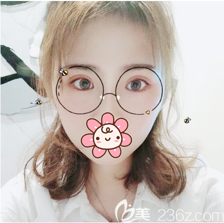 我和閨蜜結(jié)伴去深圳麗港麗格找劉虎做了全切雙眼皮,大家看看效果怎么樣