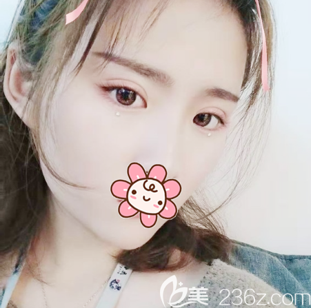 深圳麗港麗格劉虎做的雙眼皮案例