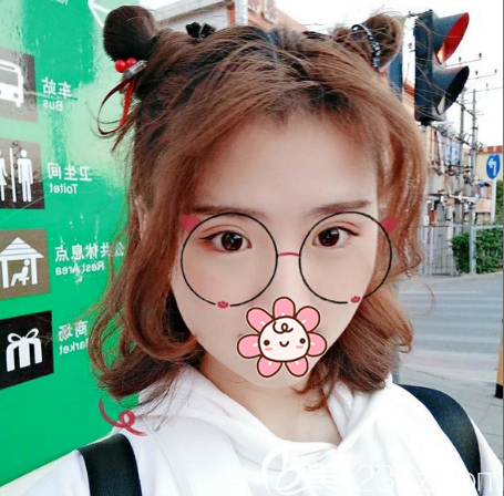 全切雙眼皮術(shù)后20天的效果