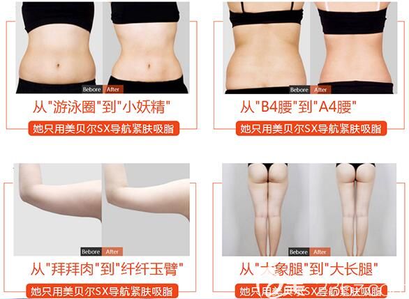 揚州美貝爾SX導(dǎo)航吸脂案例對比 揚州美貝爾SX導(dǎo)航吸脂案例對比