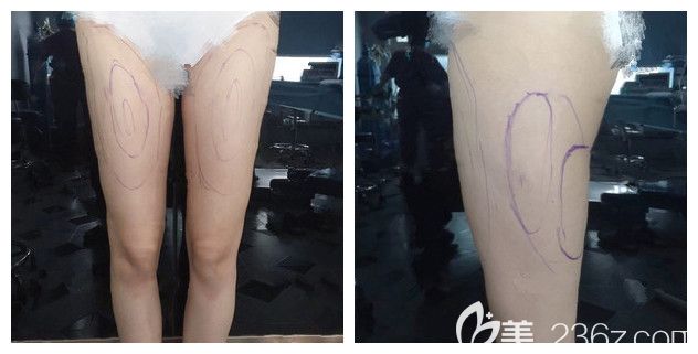 面診揚州美貝爾術(shù)前大粗腿明顯 面診揚州美貝爾術(shù)前大粗腿明顯