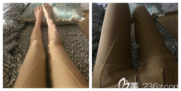 做完大腿吸脂術(shù)后三天穿著塑身衣 做完大腿吸脂術(shù)后三天穿著塑身衣